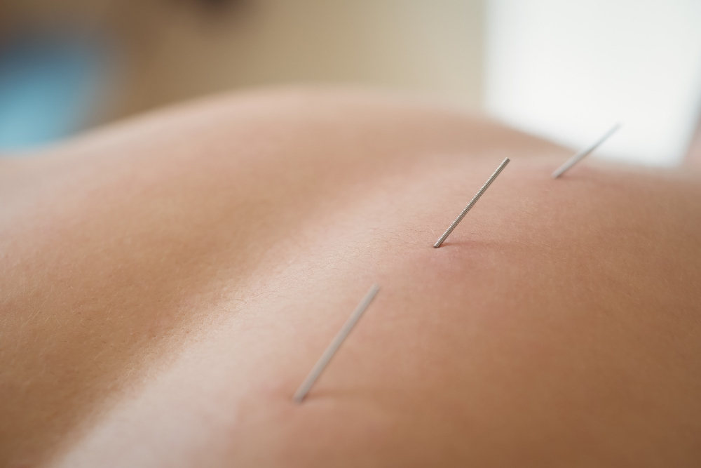 Acupuncture