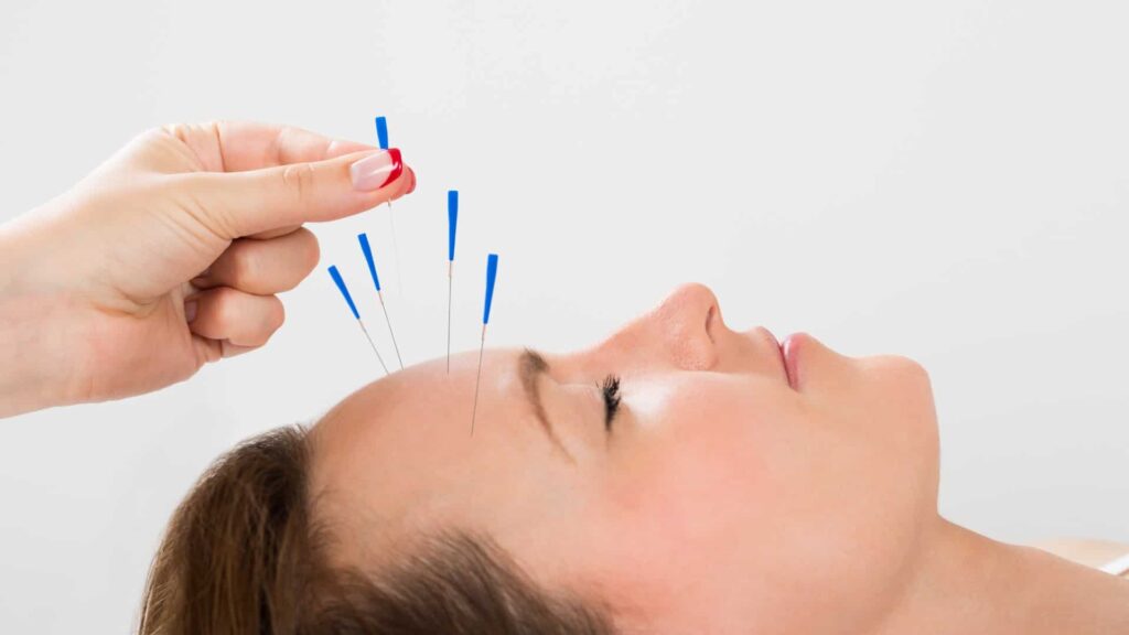 Acupuncture For Hormonal Migraines