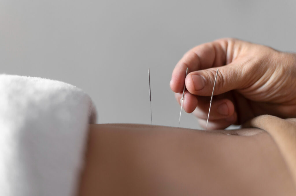 Acupuncture for Digestive